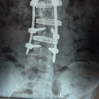 r/spinalfusion - Fusion progress post