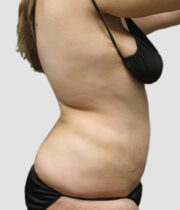 Side-profile of woman after liposuction at Sono Bello