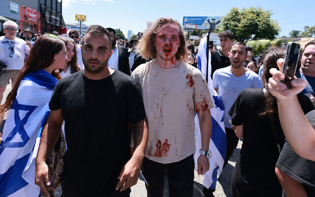 A supporter of Israel with blood on his face after clashing with pro-Palestinian protesters blocking access to the Adas Torah Orthodox synagogue, in Los Angeles, June 23, 2024. (DAVID SWANSON / AFP)