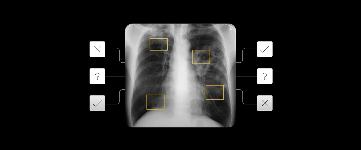 AI detects tuberculosis on chest x-rays. Image used with permission from National Library of Medicine, PubMed ID 25525580.