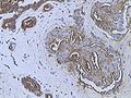 immunohistochemical assay of Mucin 1 in Braest cancer (Infiltrating ductal carcinoma of the breast)