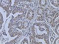 immunohistochemical assay of HER2 in Breast cancer (Infiltrating ductal carcinoma of the breast)